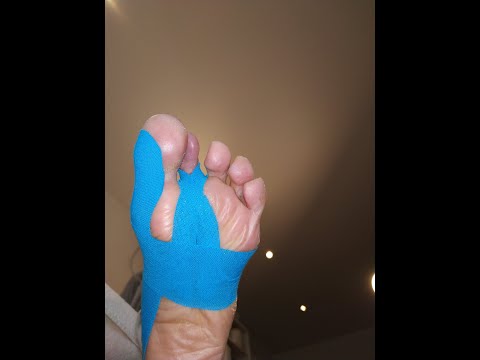 Tapen eines Krallenzehs