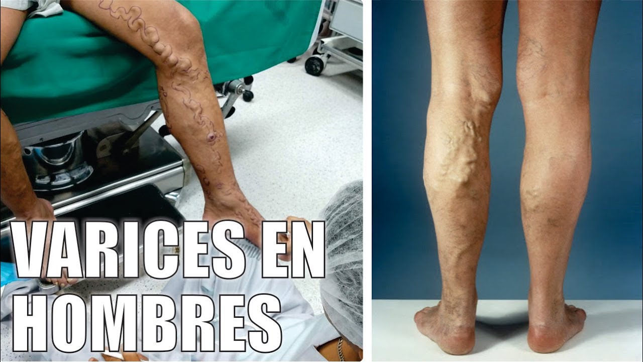 Watch ¿VÁRICES y ÚLCERAS en HOMBRES 👣 VARICES: ¿Son una ENFERMEDAD de MUJERES 🤩 Dr IVÁN GUTIÉRREZ ROMERO Now ¿VÁRICES y ÚLCERAS en HOMBRES 👣 VARICES: ¿Son una ENFERMEDAD de MUJERES 🤩 Dr IVÁN GUTIÉRREZ ROMERO
