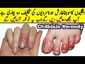 Swell Feet And Hands Treatment At Home | Easy Swelling Remedy By Zymal's Kitchen | Home Remedy