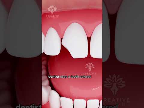 How Does Bonding Fix a Chipped Tooth #shorts #tooth - Creativelearning3d