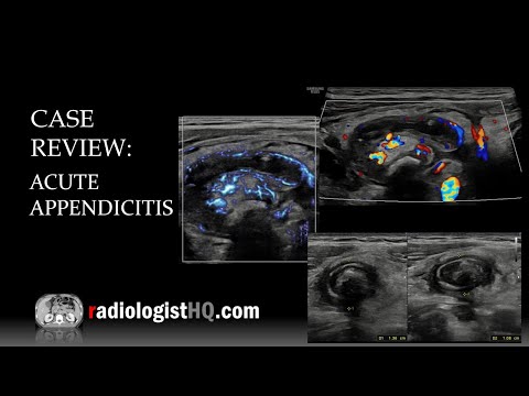 Ultrasound of Acute Appendicitis