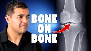 What Can You Do for BONE on BONE Knee Pain Relief? (without Surgery)