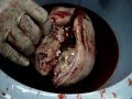 Removal of Large Teratoma Dr.Safaa Riyadh - YouTube