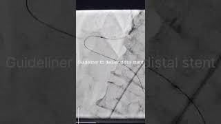 Download lagu Case 37: 'Trouble at 2 ends' Complicated reconstruction of Calcified RCA mp3 Download lagu Case 37: 'Trouble at 2 ends' Complicated reconstruction of Calcified RCA mp3