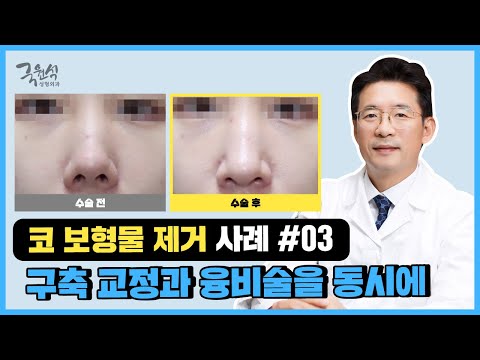 보형물 제거 후 콧대를 높이고 싶지만 문제가 또❗ 생길까 두렵다면✔✔