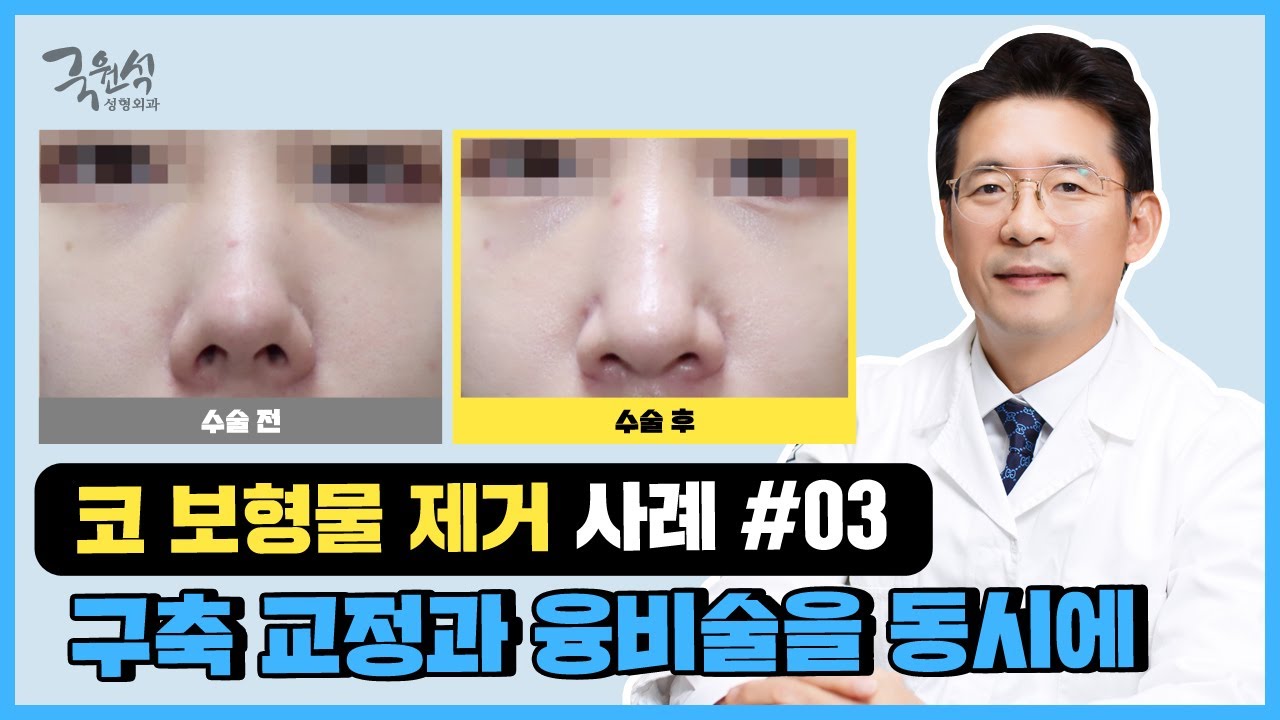 보형물 제거 후 콧대를 높이고 싶지만 문제가 또❗ 생길까 두렵다면✔✔