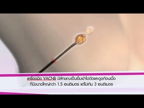 หน้าอกใหญ่ของหญิงสาว ของเหลวในหน้าอกหลังจาก mammoplasty