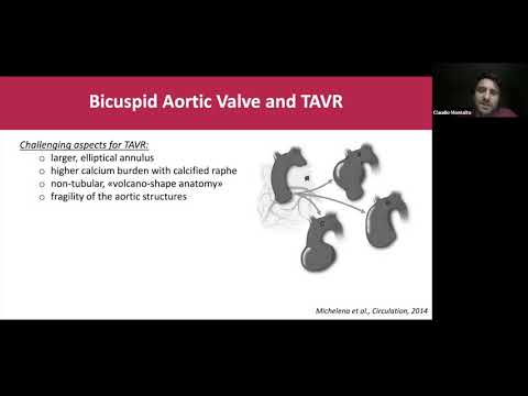 Outcomes After Transcatheter Aortic Valve Replacement in Bicuspid Versus Tricuspid Anatomy