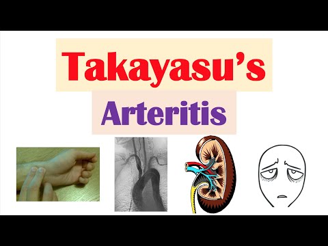 Sjogren s Syndrome Dry Eye Syndrome Primary vs Secondary Symptoms Diagnosis and Treatment