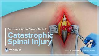 Demonstrating the Surgery Behind Catastrophic Spinal Injury