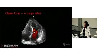 Acquired Left Ventricular Pathology – Dr Julie Humphries