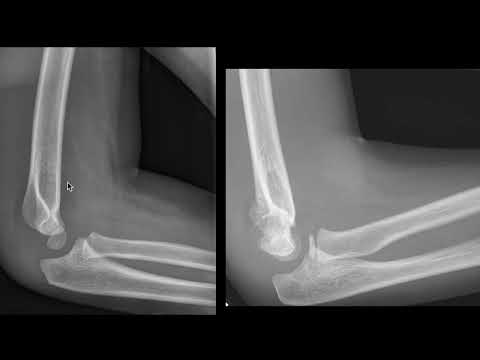 Occult Supracondylar Fracture: The Elbow Fat Pad Sign Explained