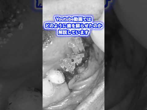 生命歯学科 ２０年間奥歯で物を噛めなかった患者さんが涙した歯を蘇らせる方法とは・・・ #口腔外科 ＃歯の移植 #親知らず #歯を抜かない #shorts