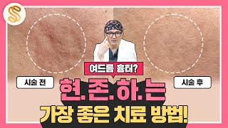 치료 효과 의심? 없애드리겠습니다!ㅣ여드름 흉터, 없애는법, 시술, 치료, 효과
