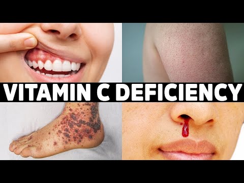 Calcium and Magnesium Absorption Basics – Dr Berg