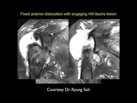 Shoulder | Shoulder Instability Pt  2