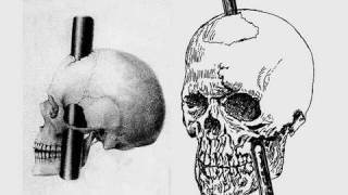 Stabbed in the Brain: Phineas Gage