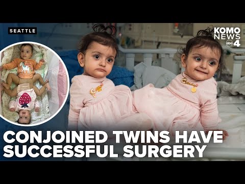 Conjoined twin girls undergo rare separation surgery at Seattle Children's Hospital