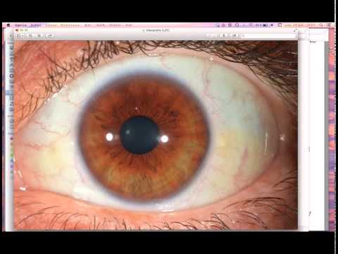 Myopia és hyperopia látás táblázatok