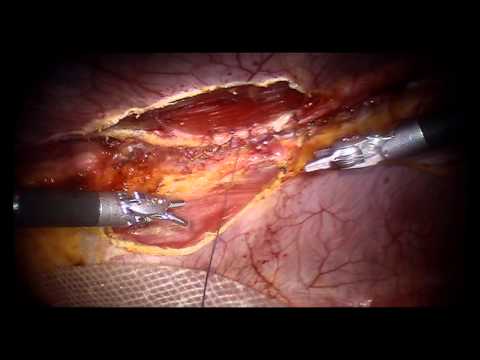 robotic ventral hernia narrated