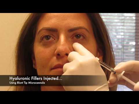 Hyaluronic acid to fill under eyes