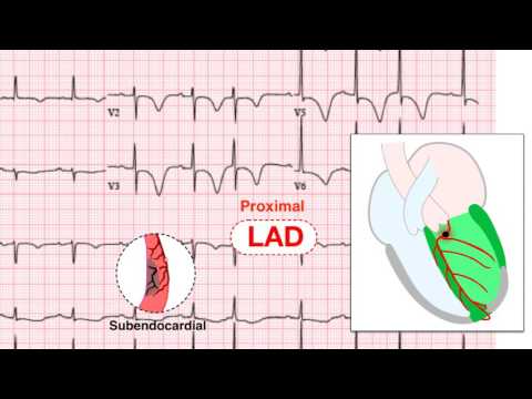 Ischemia 5/7 -Examples of UA and NSTEMI