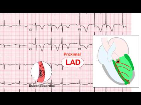 Cardiogram szív hipertónia