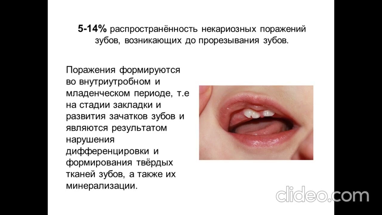 Болезни кариеса. Классификация. Этиология. Патогенез. Клинические проявлени