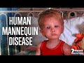 World's Rarest Disease: The Human Mannequin | Documentary
