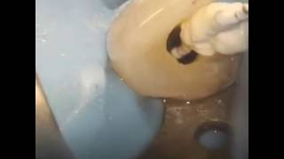 Download lagu Calcium hydroxide placement in endodontics mp3 Download lagu Calcium hydroxide placement in endodontics mp3