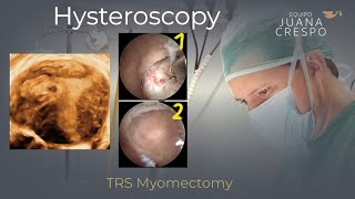 TRS Hysteroscopic Cornual Myomectomy
