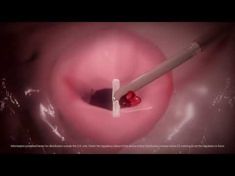 mitraclip animation abbott