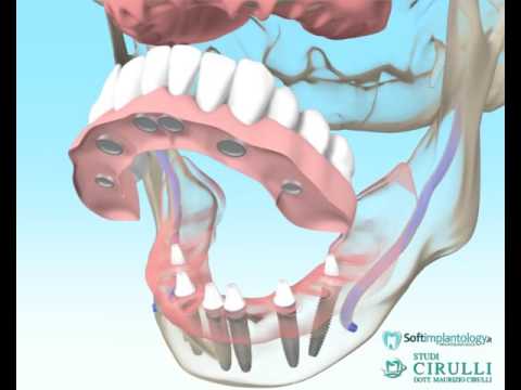Problema LFK con osteocondrosi lombare Come raddrizzare la casa comune