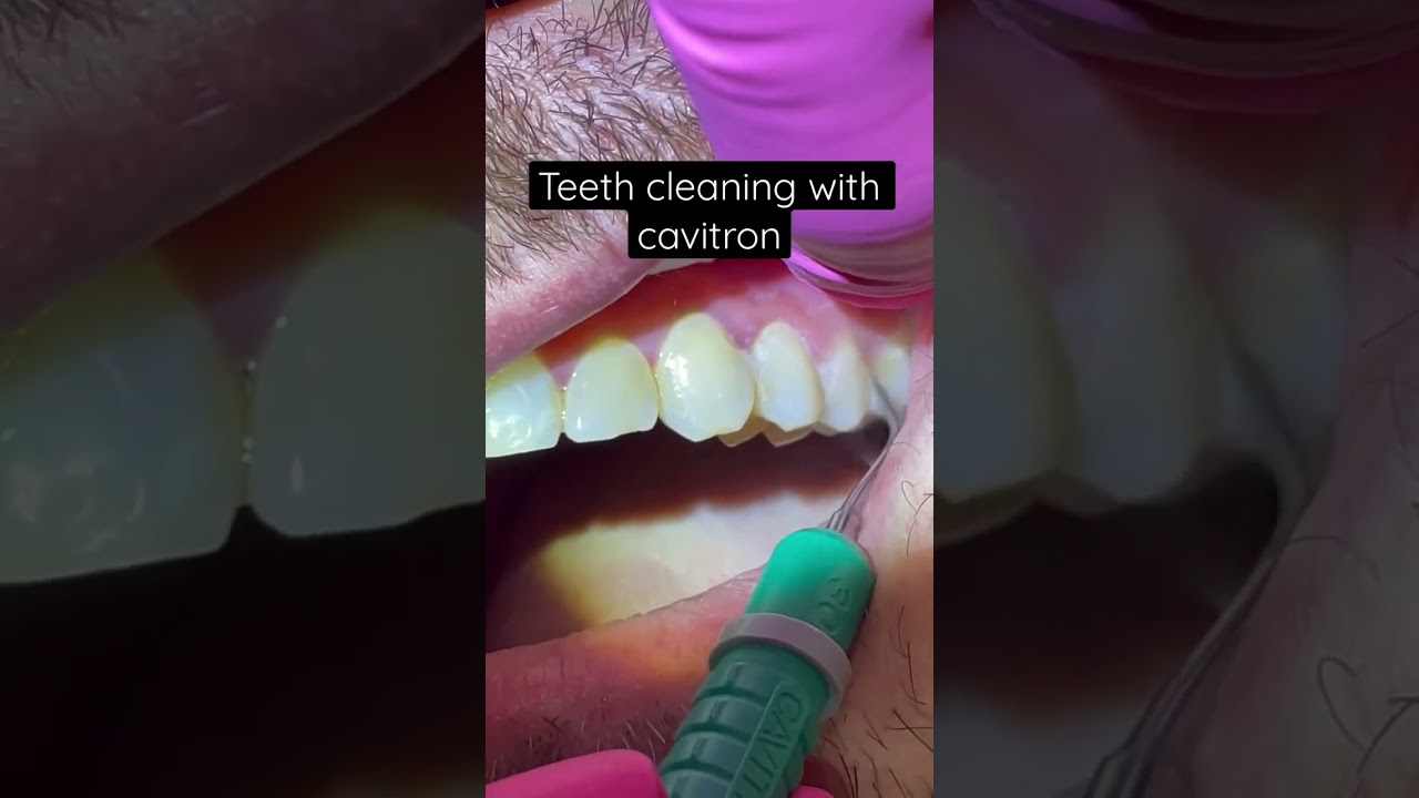 Teeth cleaning! #dentist #gingivitis #teethcleaning #teeth #cleanteeth #shorts #dentalhygiene