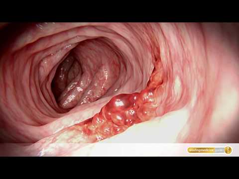 Akute Prostatitis, ob Sex sein kann Prostamol Preis in Biisk