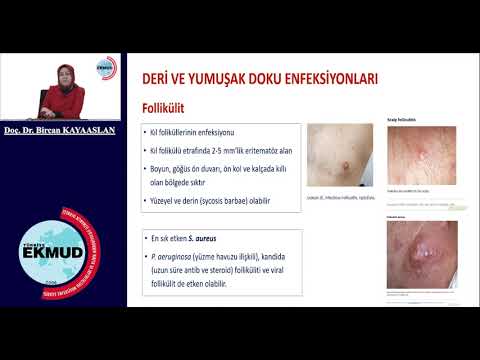 Deri ve yumuşak doku enfeksiyonlarında akılcı antibiyotik kullanımı Bircan Kayaaslan