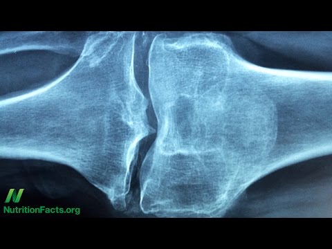 Hogyan kezelik a térd artrózisát