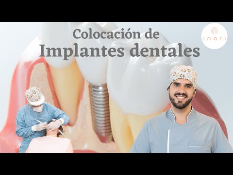 Colocación de Implantes dentales