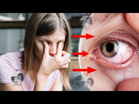 Po u dëmton rëndë shikimin, këto janë shenjat e para te verberise që nuk duhet ti neglizhoni