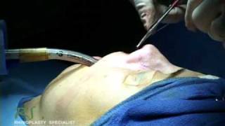 Dr. Nassif’s Closed Rhinoplasty How To – Closing Incision