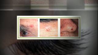 preview picture of video 'Skin Cancer Treatment Pleasanton Dermatology MD Call (925) 251-9012'