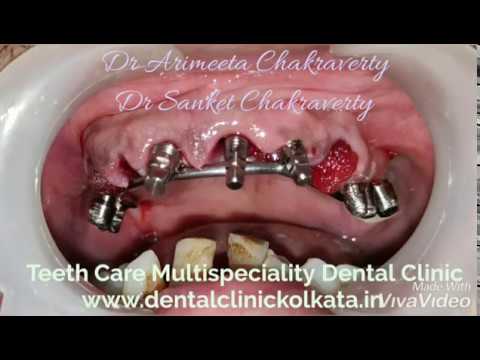 Dental Implant in Kolkata || কলকাতায় দাঁতের ইমপ্লান্ট || कोलकाता में दंत प्रत्यारोपण