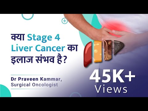 Stage 4 Liver Cancer का इलाज ? | Stage 4 Liver cancer | Liver Cancer | Dr Praveen Kammar
