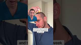 Post-Washing Your Scalp After a Hair Transplant