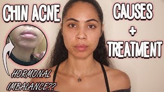 Chin Acne: Why You