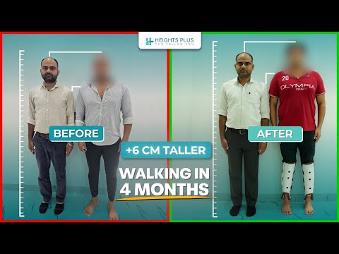 Walking in 4 Months After Limb Lengthening | Achieved 6cm Height | Height increase surgery in India
