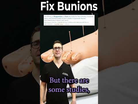 Acupuncture for Bunions Worth It? [How to Get Rid of Bunions]