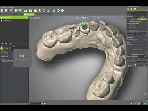 Digital Treatment planning Immediate Implant Placement-Co-Diagnostics and Synergy with Cares