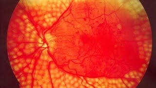 Ayurvedic treatment for Diabetic Retinopathy  