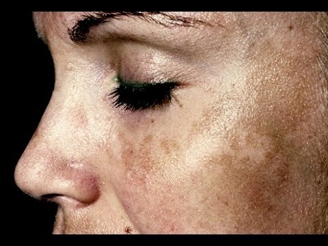 comment traiter melasma